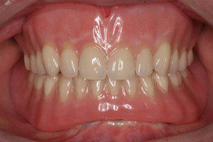 Implant Retained Dentures After