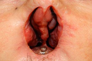 Maxillofacial Nasal Prosthesis Before