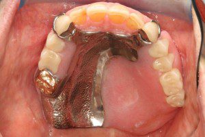 Maxillofacial Obturator After