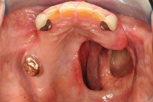 Maxillofacial Obturator Before